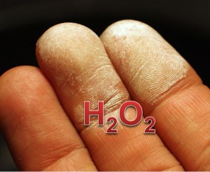 Skin damaged with 35 percent hydrogen peroxide