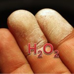 Skin damaged with 35 percent hydrogen peroxide